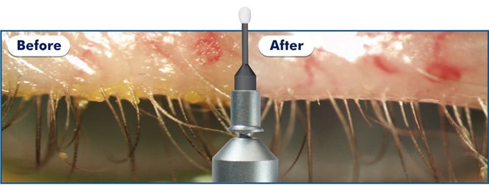 Before and After BlephEx