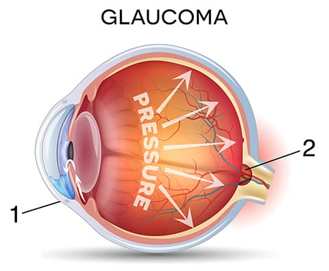 Glaucoma Diagram