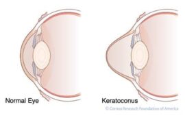 Normal Eye Vs Keratoconus