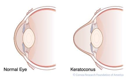 A comparison of a Normal Eye and an eye with Keratoconus