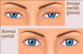 ptosis vs normal eyelids graphic