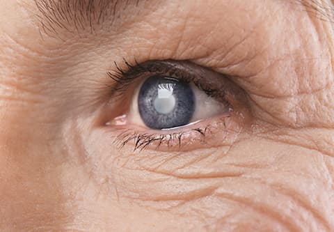 Close up of cataract in eye of senior woman